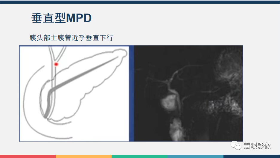【PPT】胰腺解剖变异、发育异常及相关病变影像评估-7