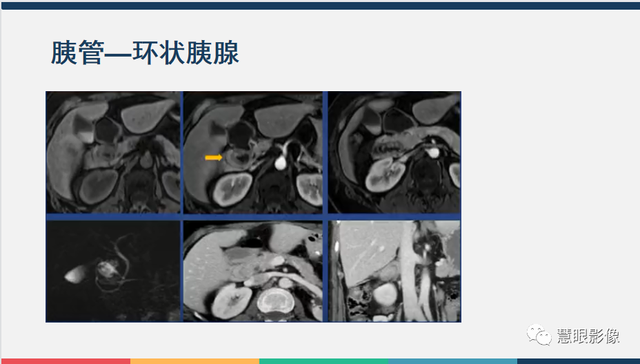 【PPT】胰腺解剖变异、发育异常及相关病变影像评估-26