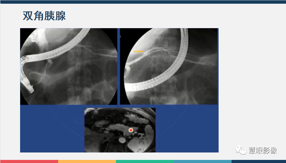 【PPT】胰腺解剖变异、发育异常及相关病变影像评估-13