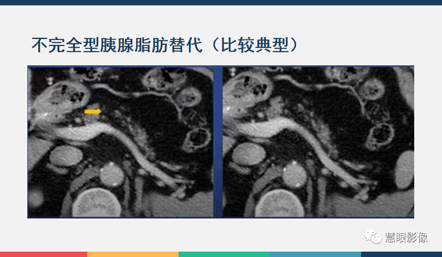 【PPT】胰腺解剖变异、发育异常及相关病变影像评估-31
