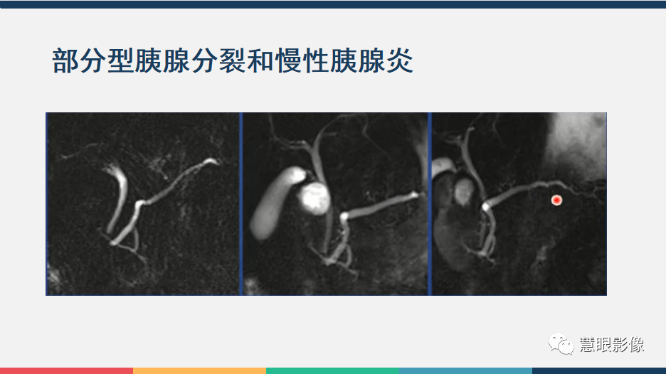 【PPT】胰腺解剖变异、发育异常及相关病变影像评估-17