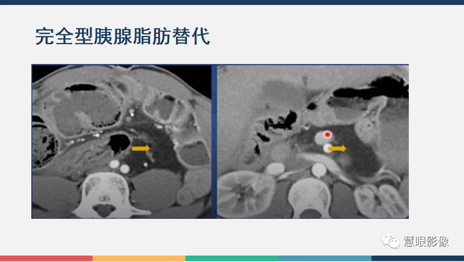 【PPT】胰腺解剖变异、发育异常及相关病变影像评估-29