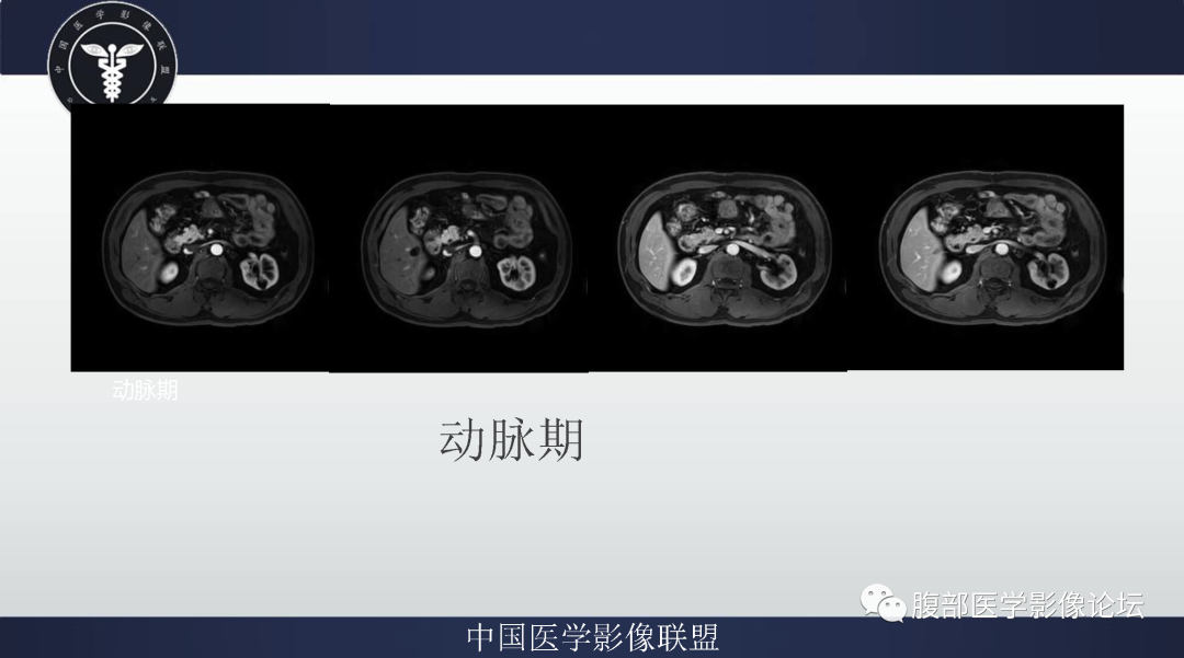 【病例】肠系膜侵袭性纤维瘤病1例MR影像-6