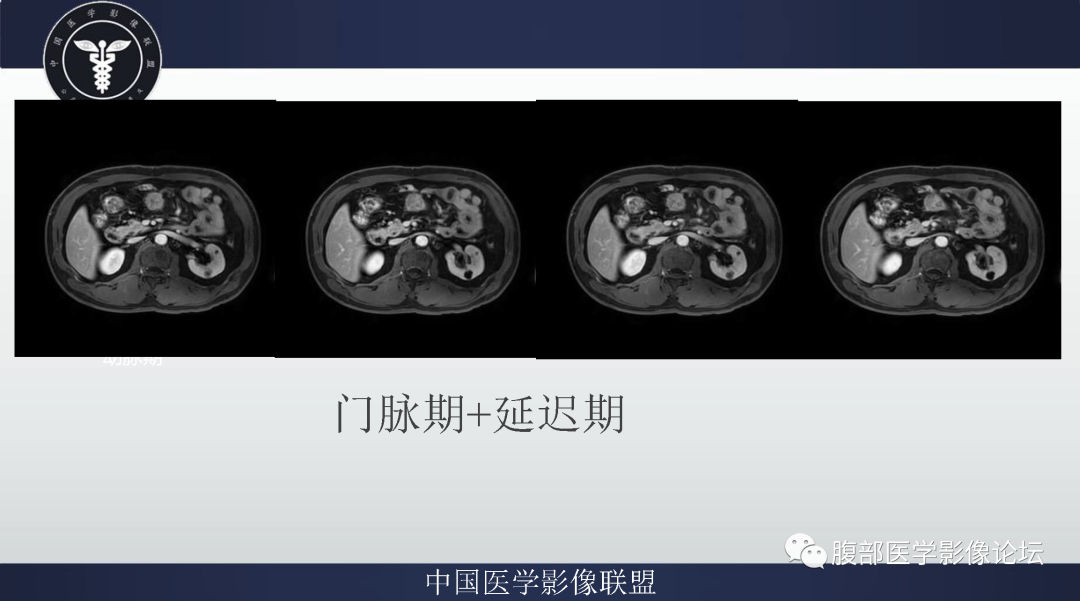 【病例】肠系膜侵袭性纤维瘤病1例MR影像-7