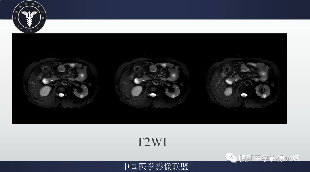【病例】肠系膜侵袭性纤维瘤病1例MR影像-4