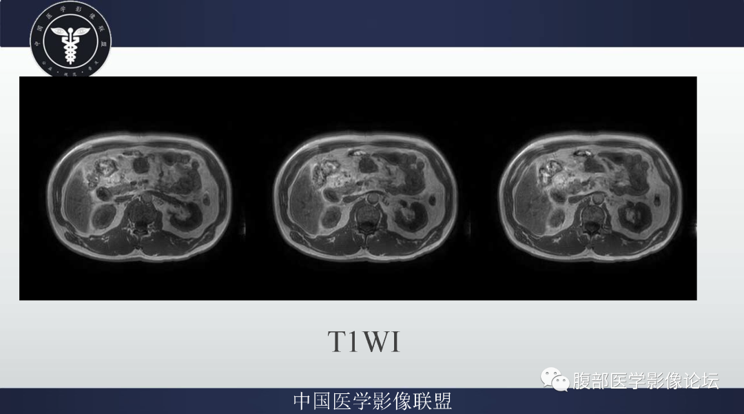 【病例】肠系膜侵袭性纤维瘤病1例MR影像-3