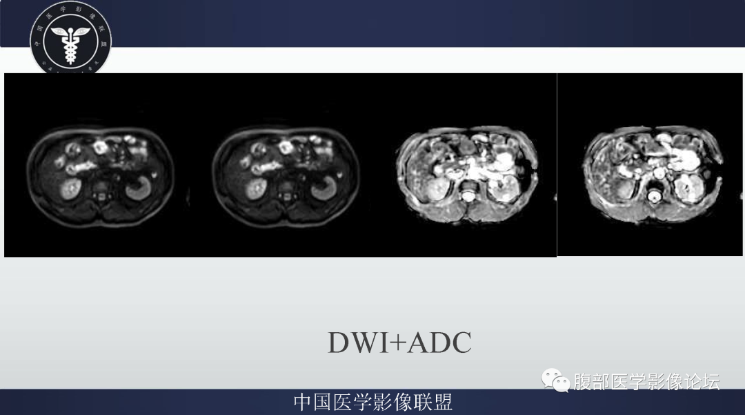 【病例】肠系膜侵袭性纤维瘤病1例MR影像-5