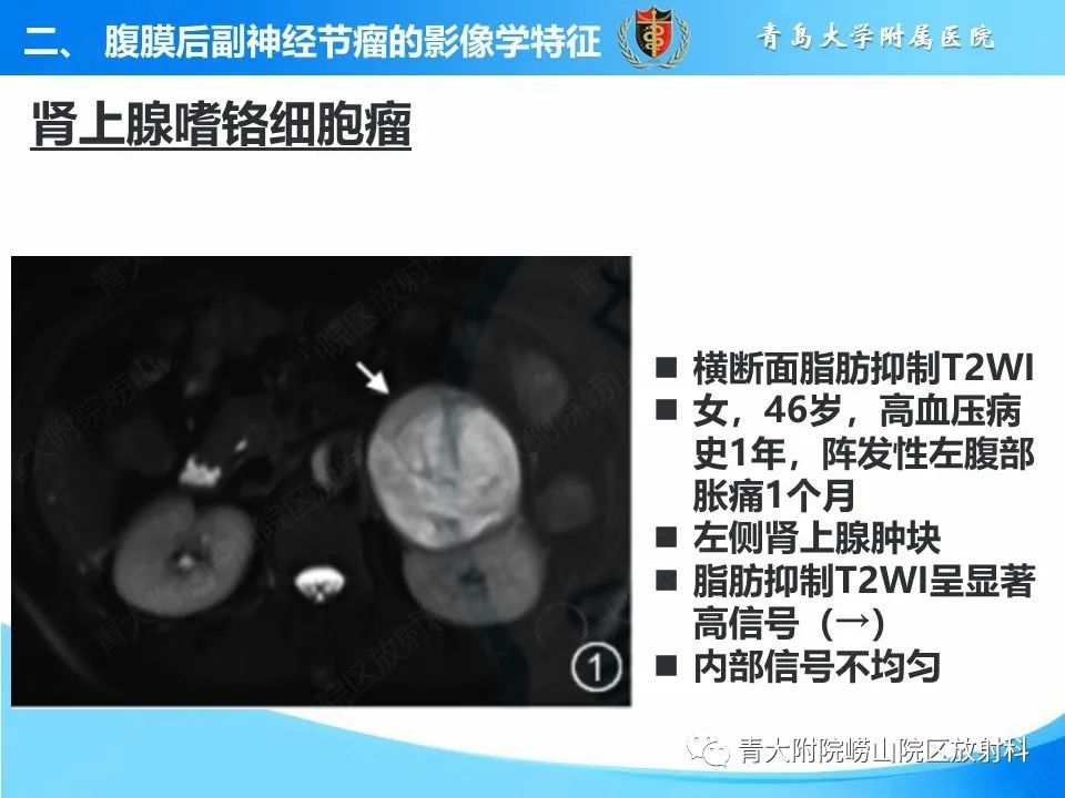 【病例】腹膜后副神经节瘤1例CT影像-21