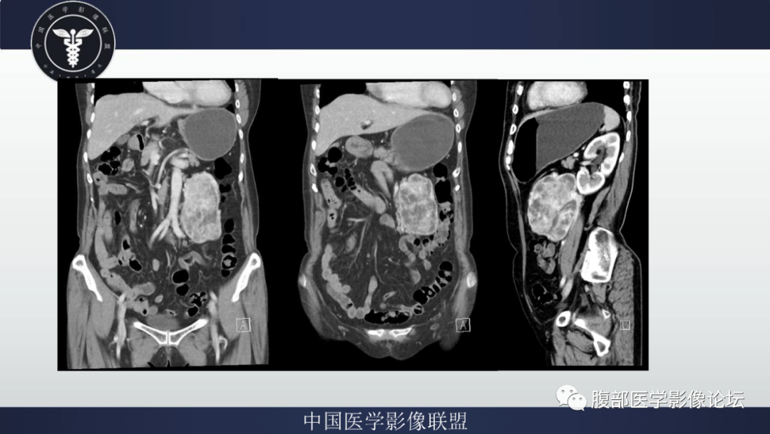 【病例】腹膜后副神经节瘤1例CT影像-8