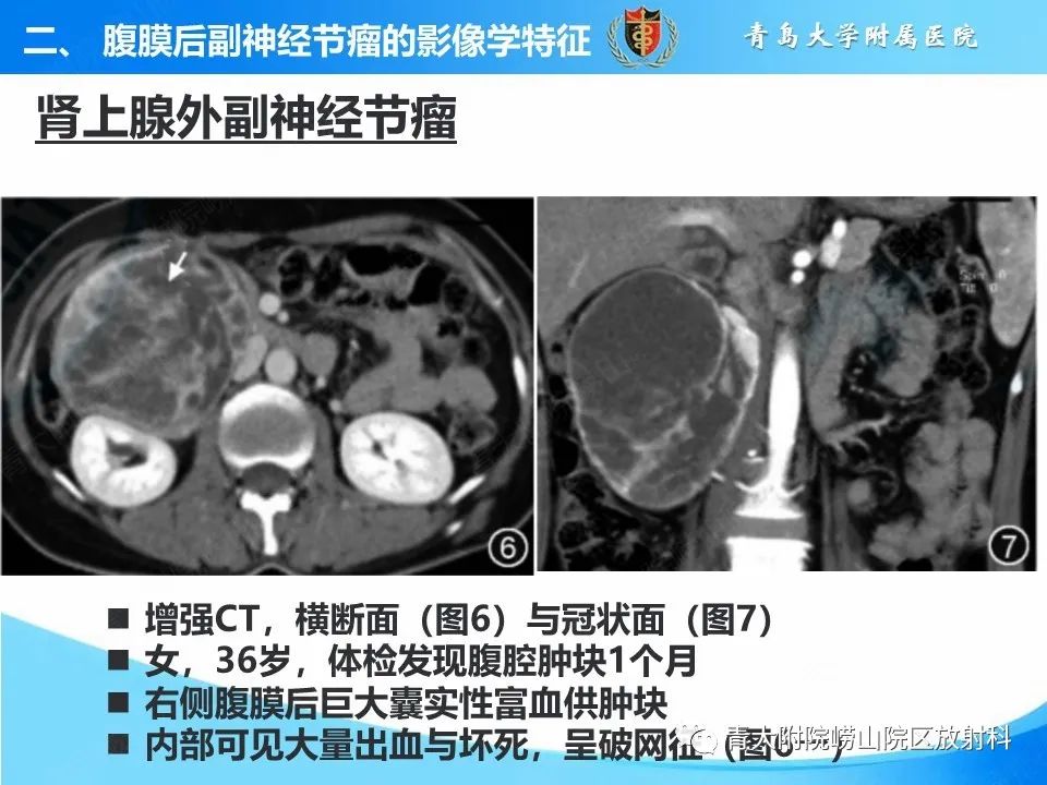 【病例】腹膜后副神经节瘤1例CT影像-30