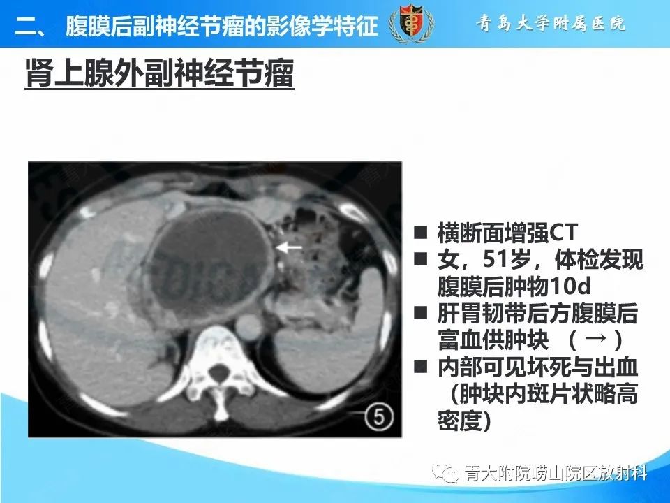 【病例】腹膜后副神经节瘤1例CT影像-29