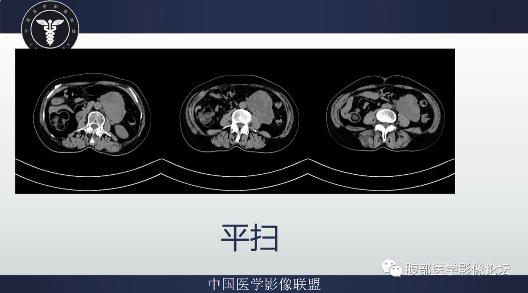 【病例】腹膜后副神经节瘤1例CT影像-4
