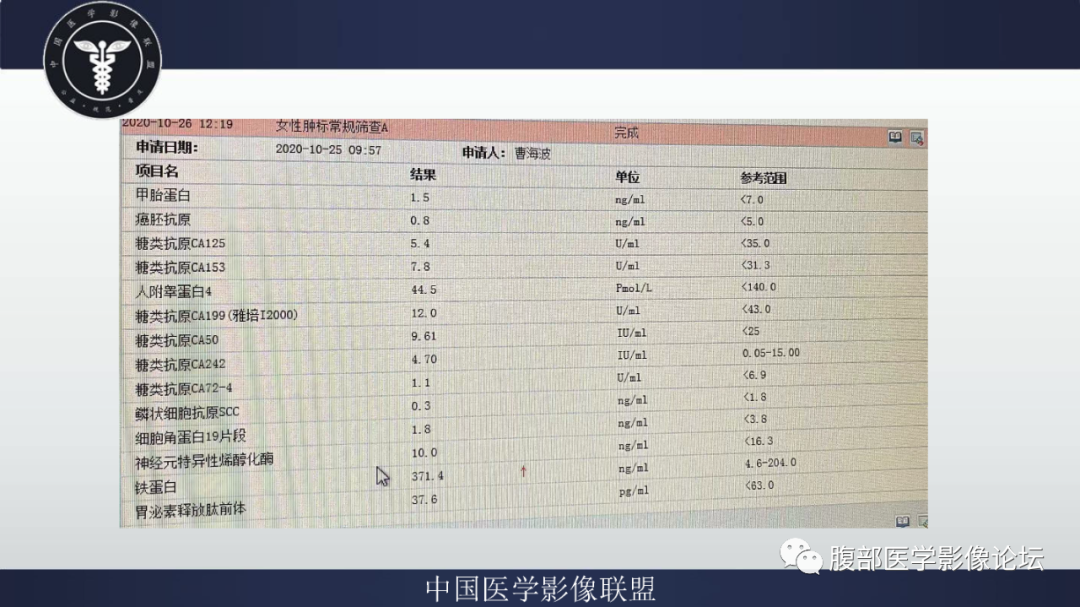 【病例】腹膜后副神经节瘤1例CT影像-3