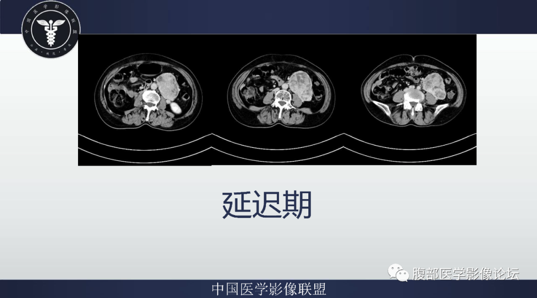 【病例】腹膜后副神经节瘤1例CT影像-7
