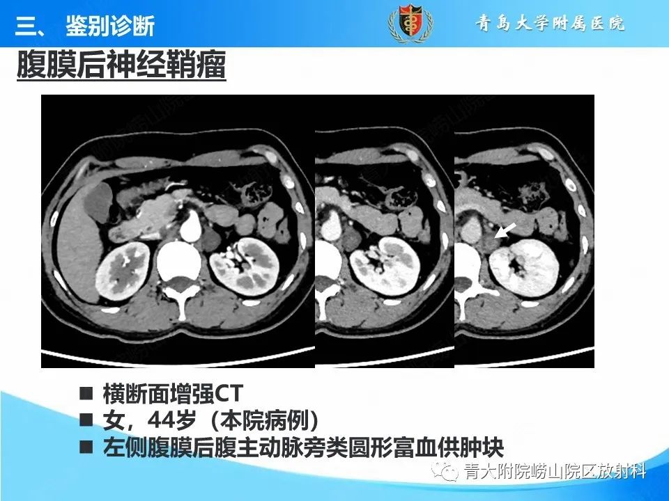 【病例】腹膜后副神经节瘤1例CT影像-41
