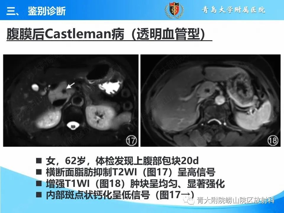 【病例】腹膜后副神经节瘤1例CT影像-48