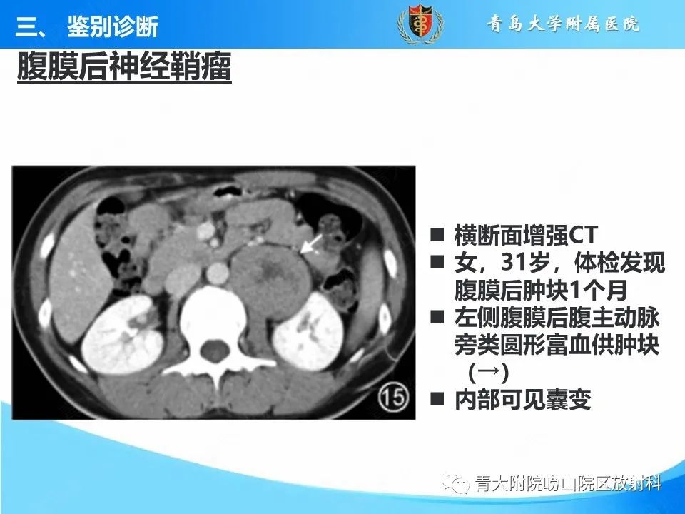 【病例】腹膜后副神经节瘤1例CT影像-40