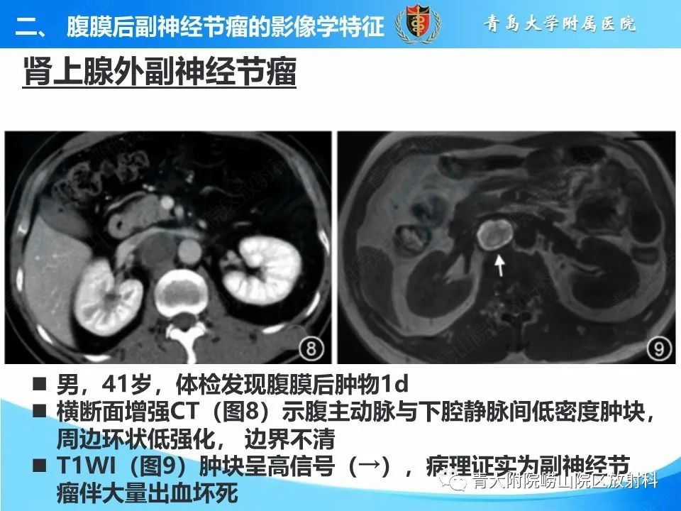 【病例】腹膜后副神经节瘤1例CT影像-32
