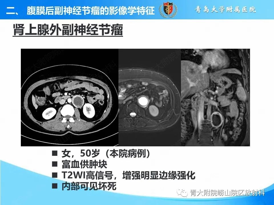 【病例】腹膜后副神经节瘤1例CT影像-26