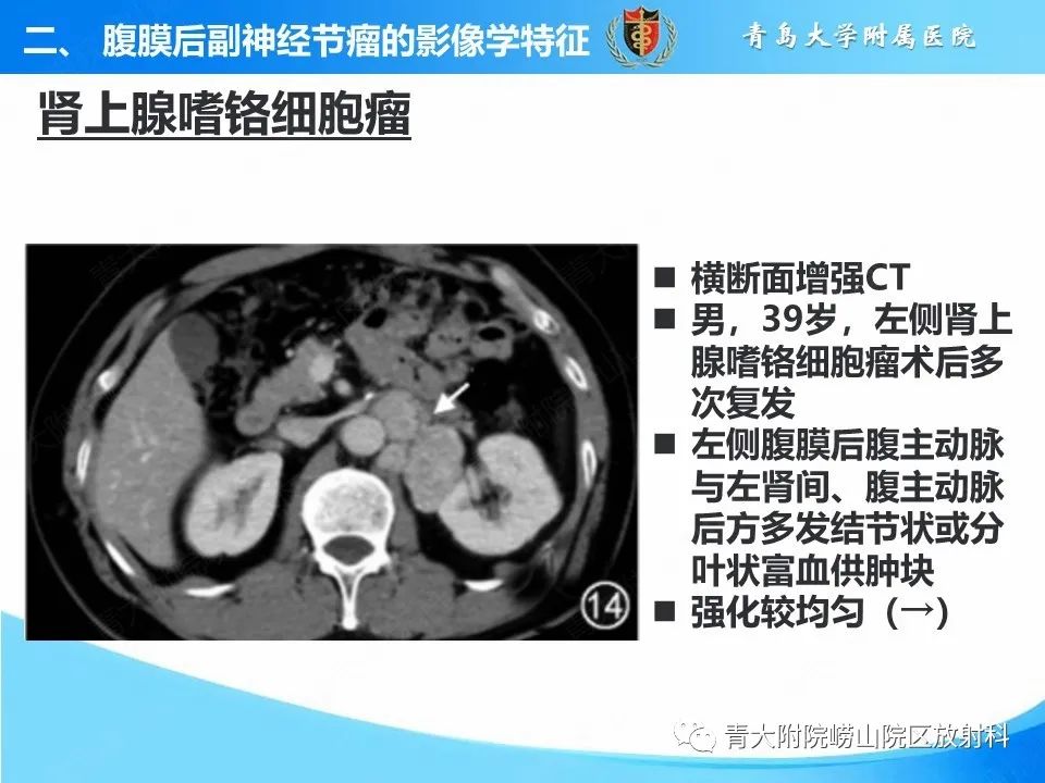 【病例】腹膜后副神经节瘤1例CT影像-36