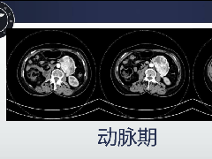 腹膜后副神经节瘤1例CT影像