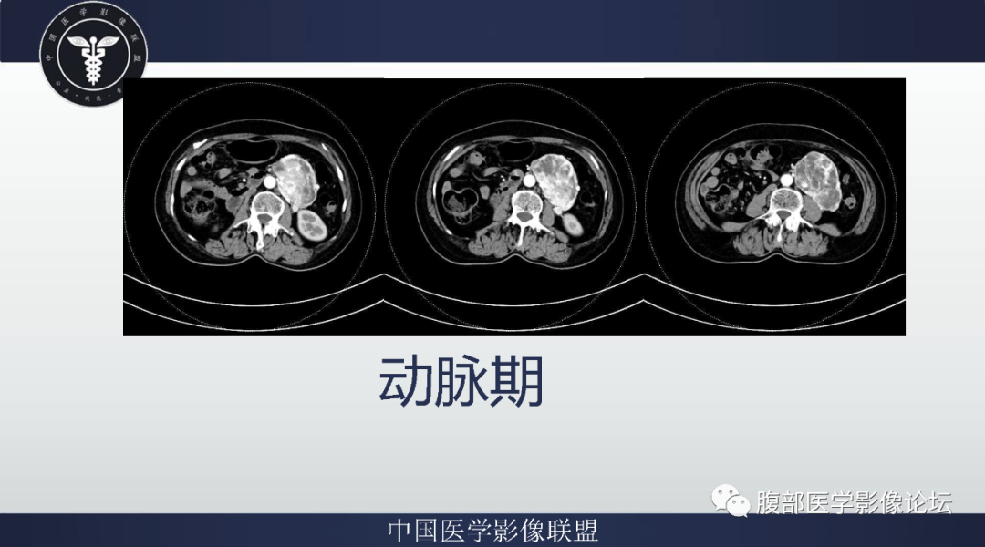 【病例】腹膜后副神经节瘤1例CT影像-5