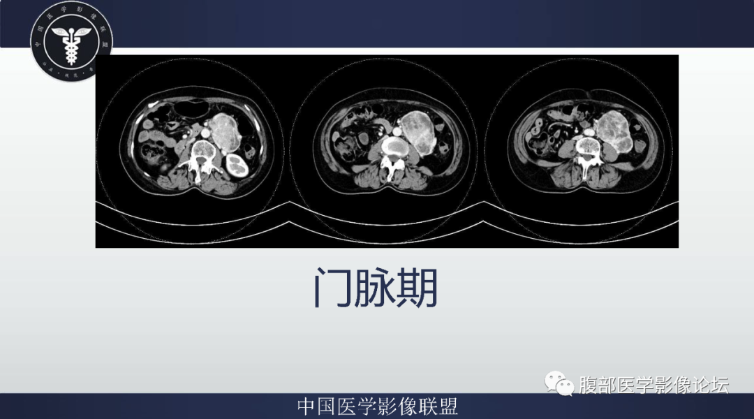 【病例】腹膜后副神经节瘤1例CT影像-6