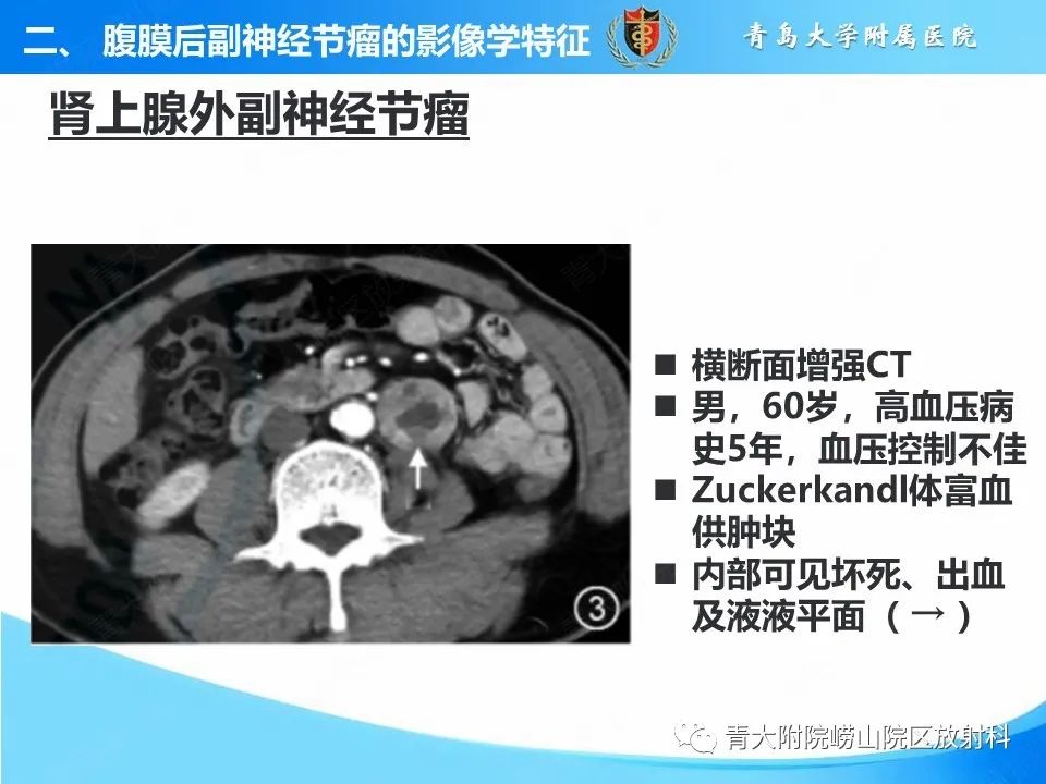 【病例】腹膜后副神经节瘤1例CT影像-25