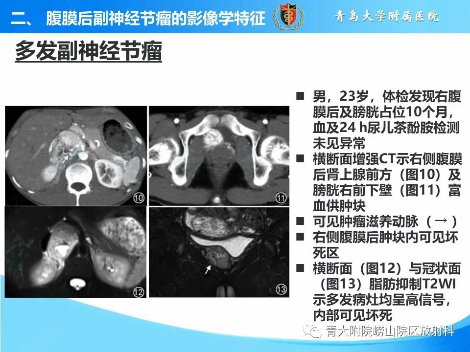 【病例】腹膜后副神经节瘤1例CT影像-33