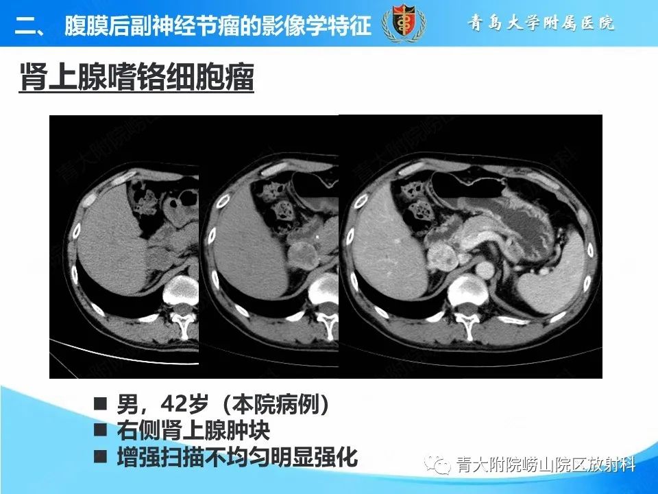 【病例】腹膜后副神经节瘤1例CT影像-1