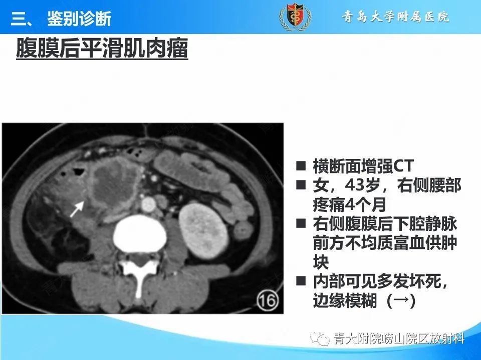 【病例】腹膜后副神经节瘤1例CT影像-44