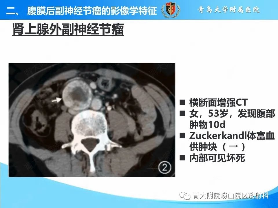 【病例】腹膜后副神经节瘤1例CT影像-24
