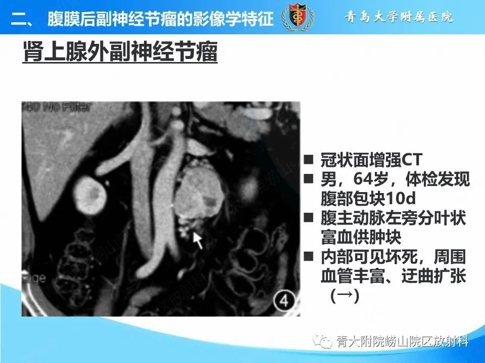 【病例】腹膜后副神经节瘤1例CT影像-28