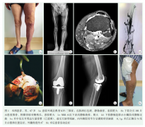 Klippel-Trenaunay综合征膝严重退变全膝置换1例