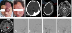 以巨大额面部血管瘤为表现的Sturge-weber综合征1例