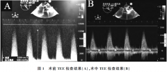 TEE辅助下急诊TAVR抢救重度主动脉瓣狭窄合并心源性休克老年患者1例