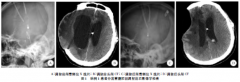 脑室-腹腔分流术后分流系统堵塞