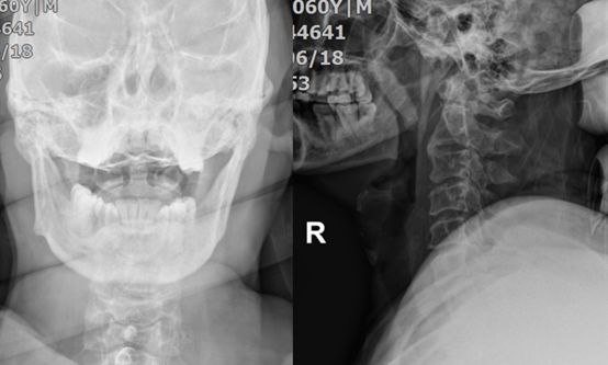 无骨折脱位型颈脊髓损伤的诊疗分析