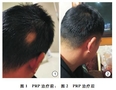 血袋法制备富血小板血浆治疗斑秃１例