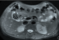 坏疽性胆囊炎合并胆囊-十二指肠内瘘1例