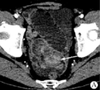 多层螺旋CT扫描及后处理技术诊断小肠肉瘤样癌3例报道