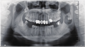 下颌乙状切迹异位第三磨牙伴含牙囊肿1例