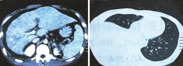 图2-避免先入为主！肝脾大、腹水不一定是肝硬化……  临床实战.jpg