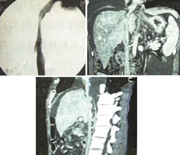 图3-避免先入为主！肝脾大、腹水不一定是肝硬化……  临床实战.jpg