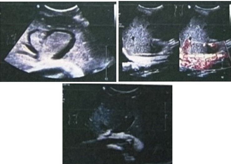 图1-避免先入为主！肝脾大、腹水不一定是肝硬化……  临床实战.jpg
