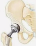 人工双动股骨头置换术后假体周围骨折并脱位1例