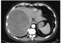 肝脏恶性间皮瘤超声造影表现1例