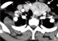 <b>甲状腺滤泡癌下颌骨及肋骨转移1例</b>
