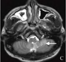 新型隐球菌性脑膜脑炎3例MRI征象