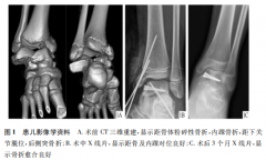 儿童距骨体粉碎性骨折合并内踝骨折1例